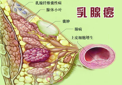 乳腺癌病因